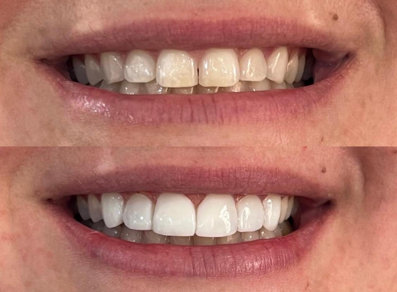 Antes e depois de tratamento com facetas, caso um