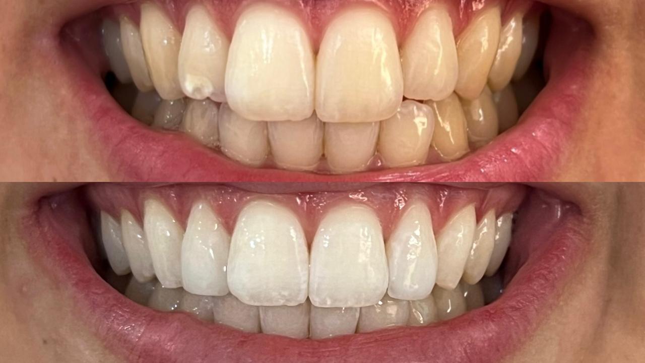Antes e depois de tratamento com facetas, caso três