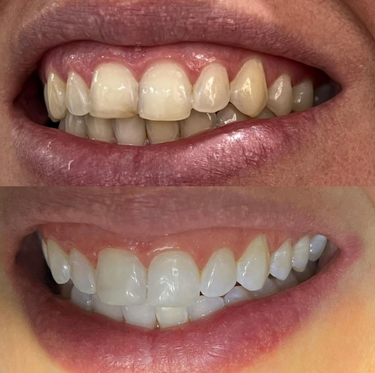 Antes e depois de clareamento dental, caso um