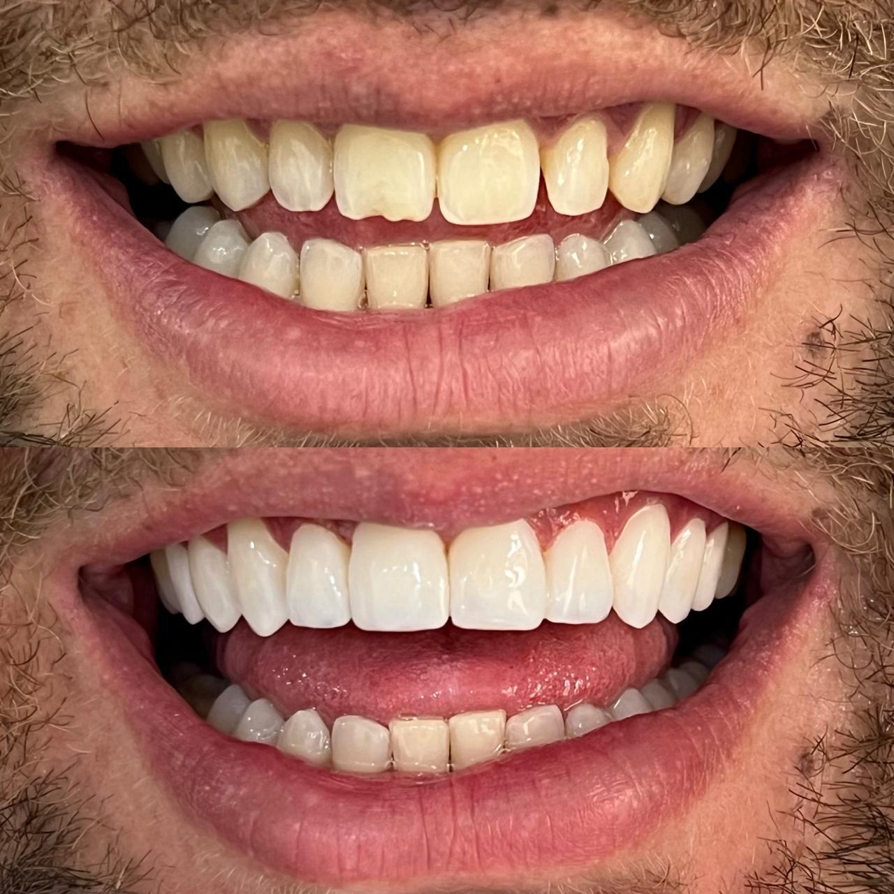 Antes e depois de tratamento com facetas, caso dois