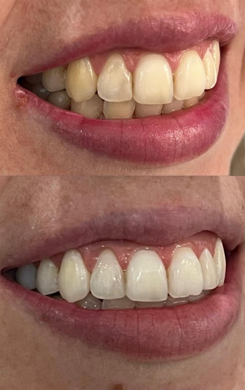 Antes e depois de clareamento dental, caso dois