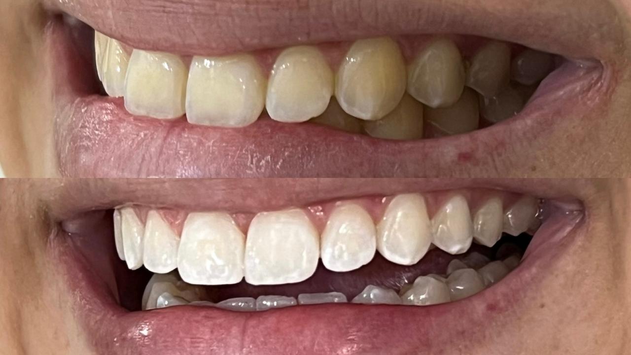 Antes e depois de clareamento dental, caso três